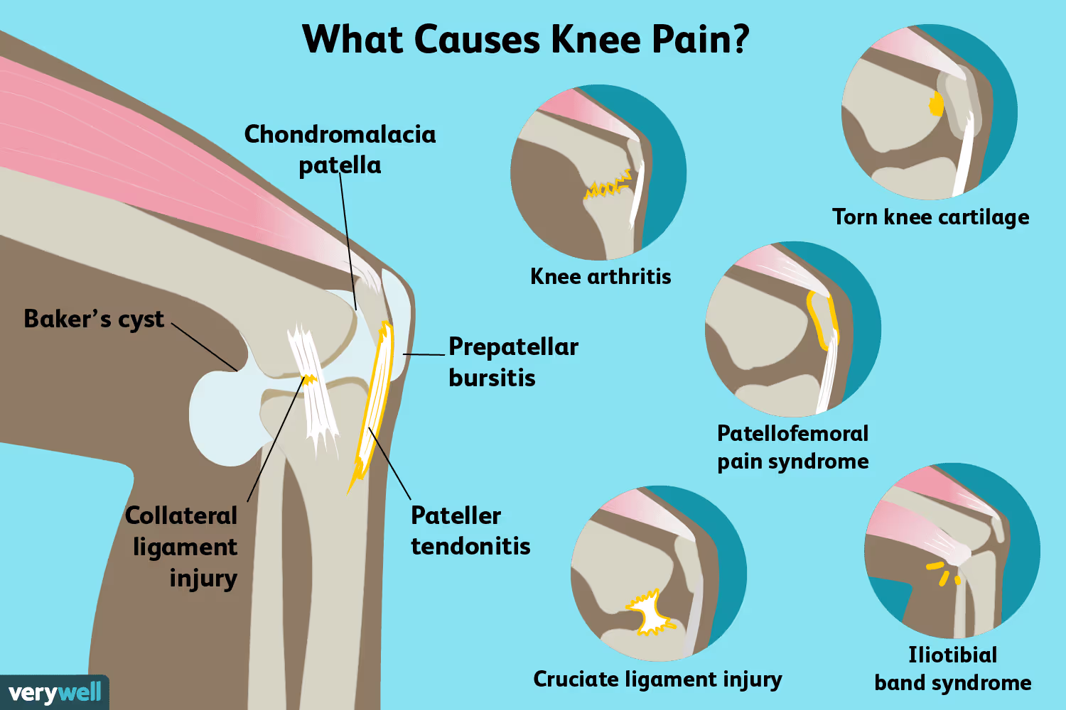 Knee Pain: Causes, Diagnosis, and Treatment