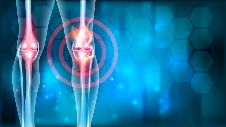 How Knee Osteoarthritis Impacts Your Quality of Life
