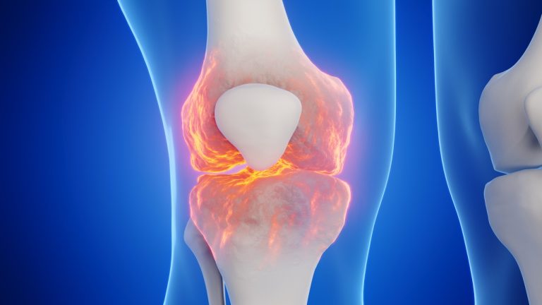 A close-up 3D medical illustration of a human knee joint glowing with red and orange light to show inflammation and arthritis pain.